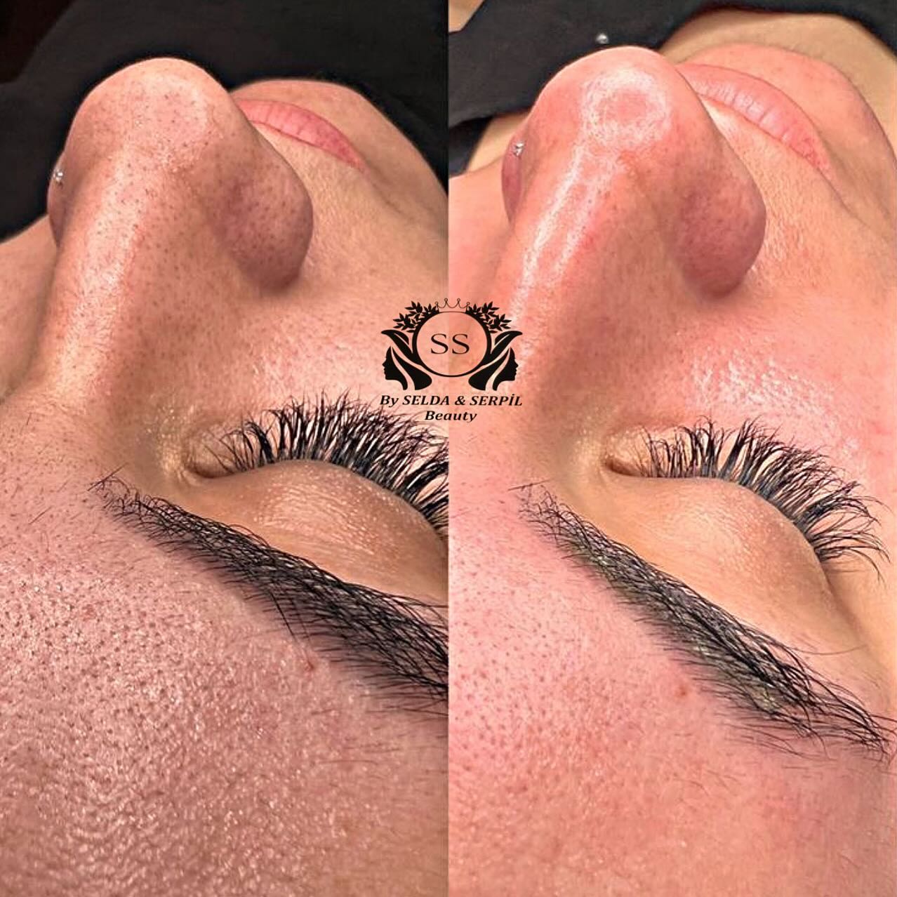 Hydrofacial Cilt Bakımı